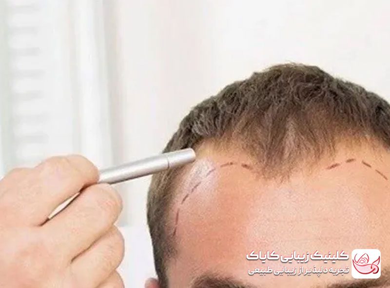 کاشت موی سر