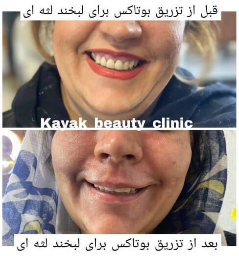 تزریق بوتاکس در کایاک