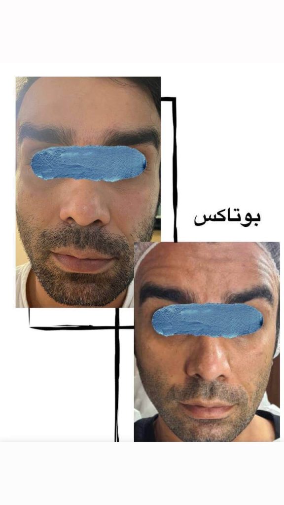 نمونه کار بوتاکس