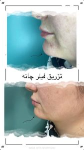 تزریق فیلر چانه