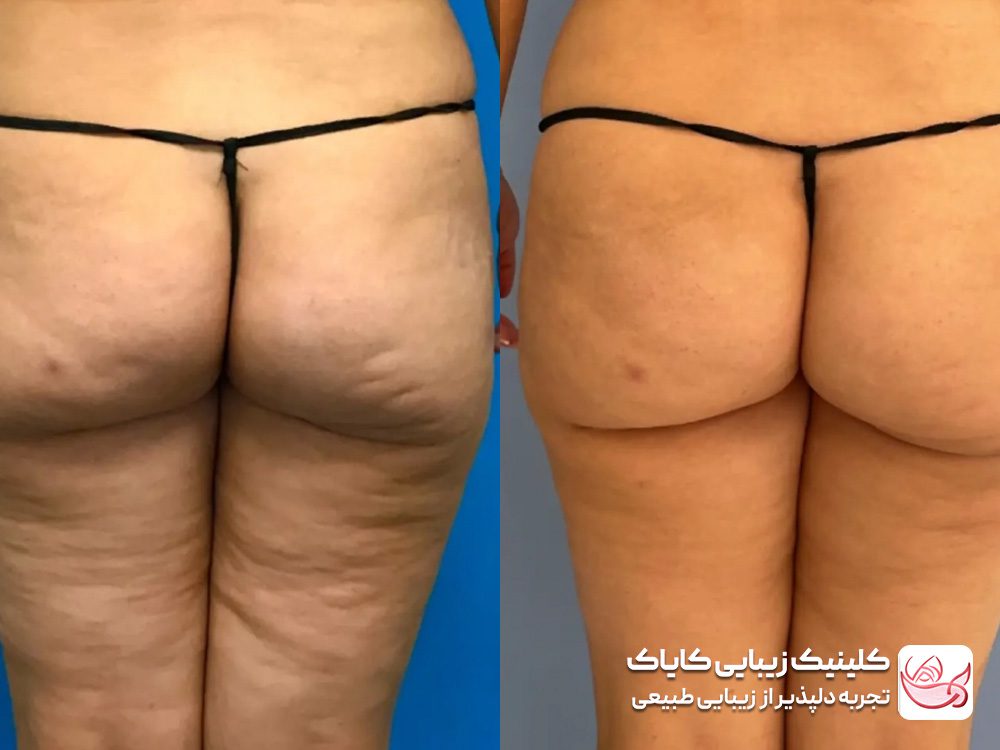 درمان سلولیت و چربی موضعی