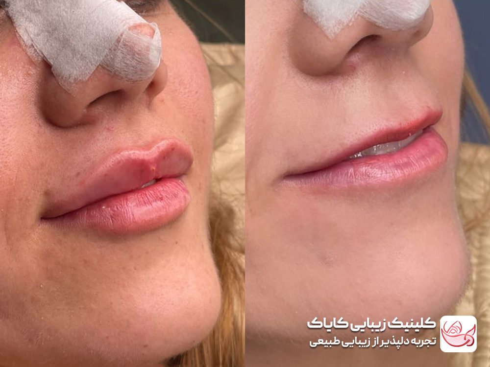 فیلر لب قبل و بعد