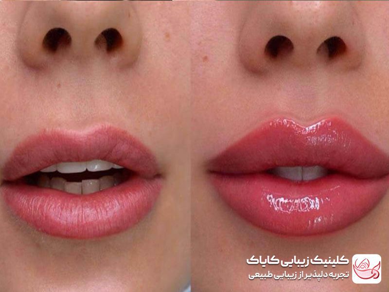 فیلر لب روسی