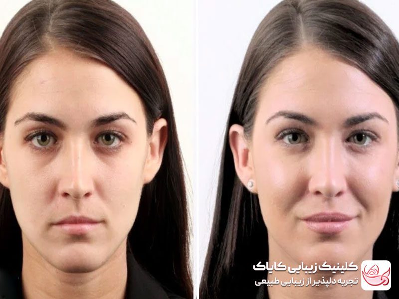 فیلر گونه قبل و بعد - فیلر صورت