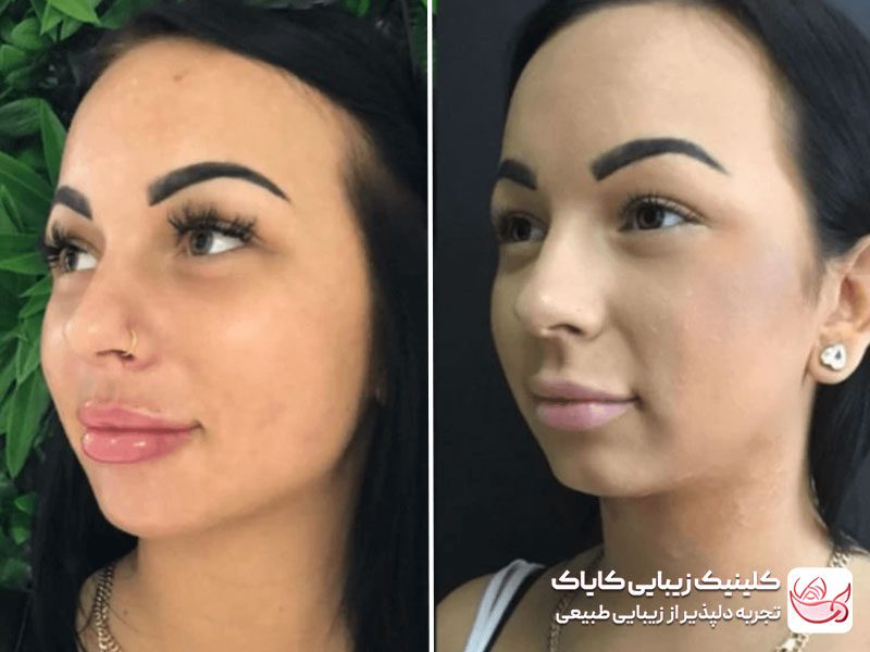 فیلر فول کانتورینگ صورت - فیلر صورت