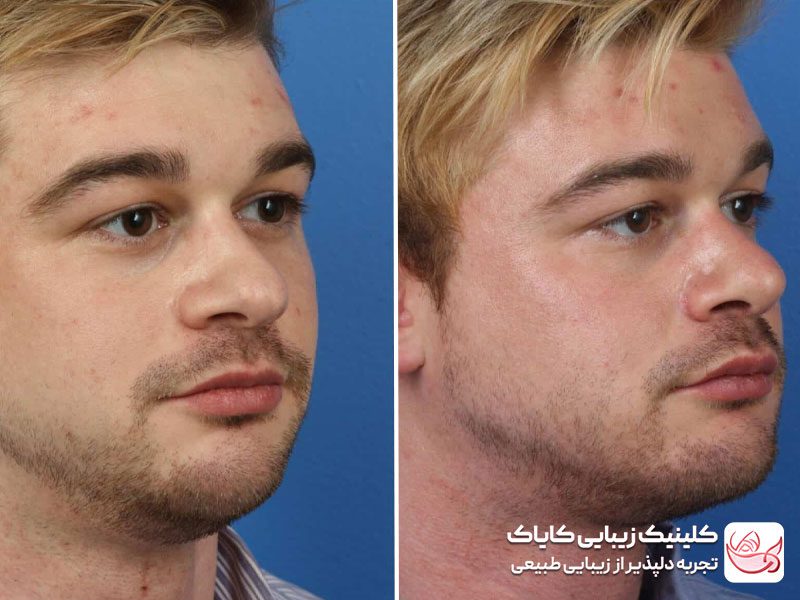 fa.png - فیلر صورت