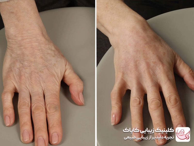 فیلر دست
