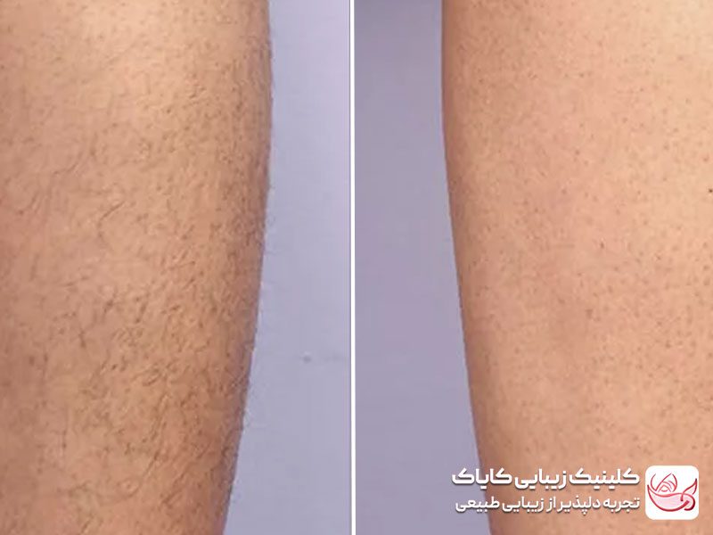 تصویر قبل و بعد حذف موهای ساق پا با لیزر فول بادی