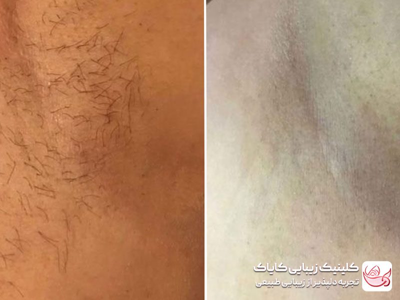 تصویر قبل و بعد حذف موهای زیربغل با لیزر فول بادی