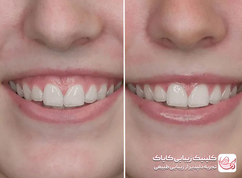 بوتاکس لبخند لثه ای قبل و بعد