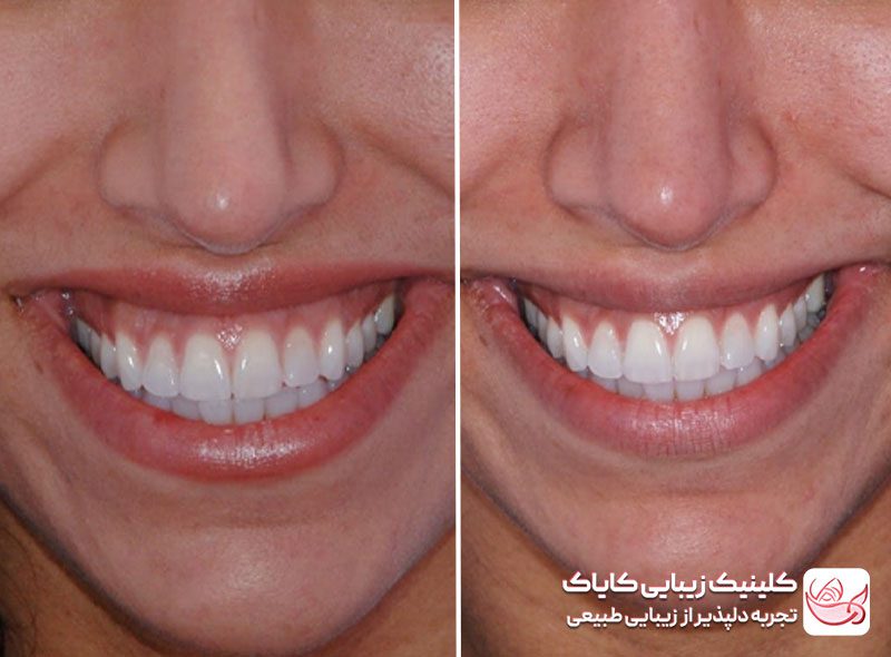 بوتاکس لبخند لثه‌ای قبل و بعد