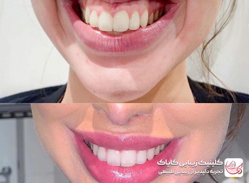 بوتاکس لبخند لثه‌ای قبل و بعد