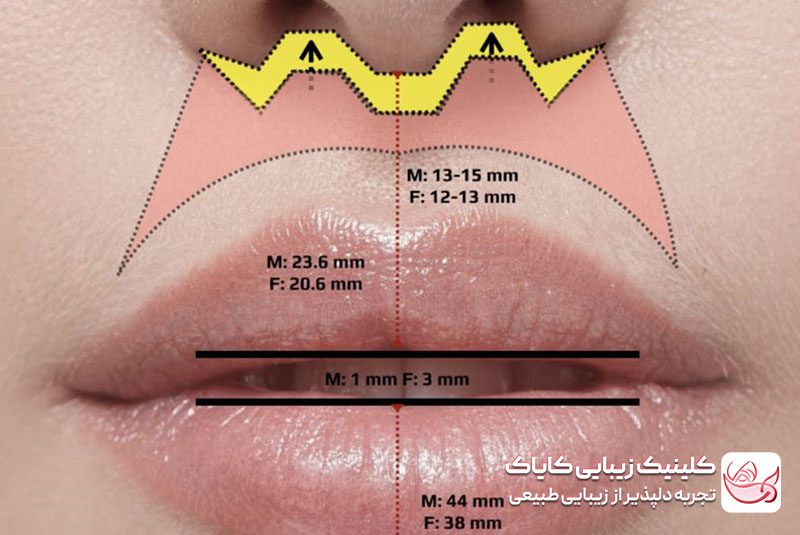لیفت لب برای فرم دهی لب ها