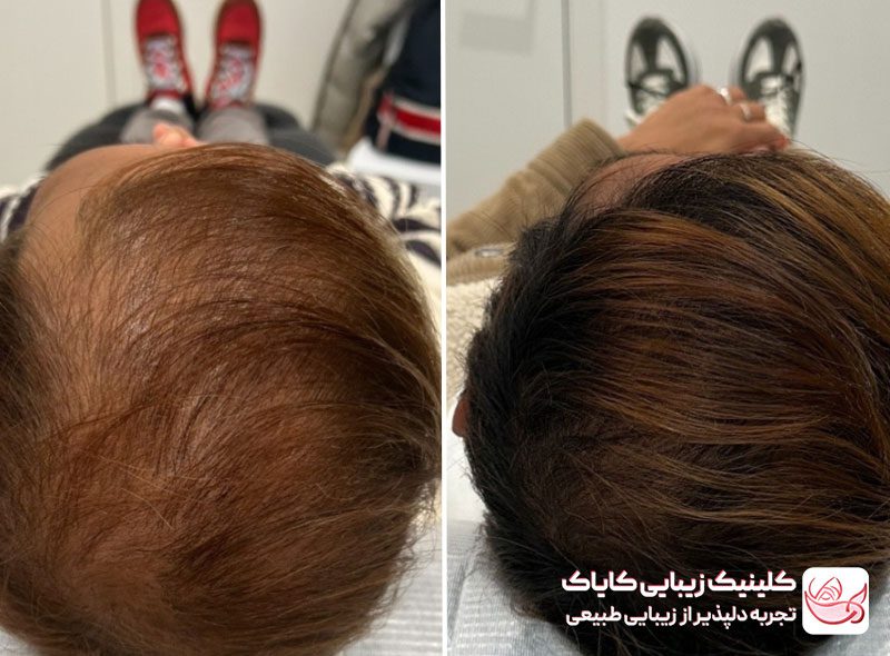 هیر فیلر قبل و بعد
