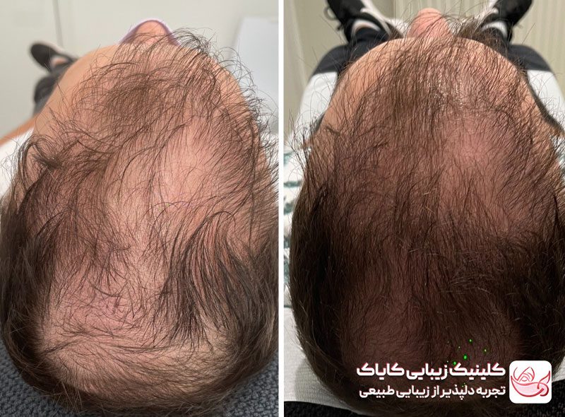 درمان ریزش مو