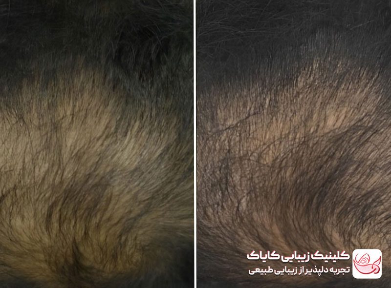 مزوتراپی مو قبل و بعد