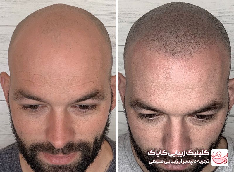 اسکالپ سر قبل و بعد