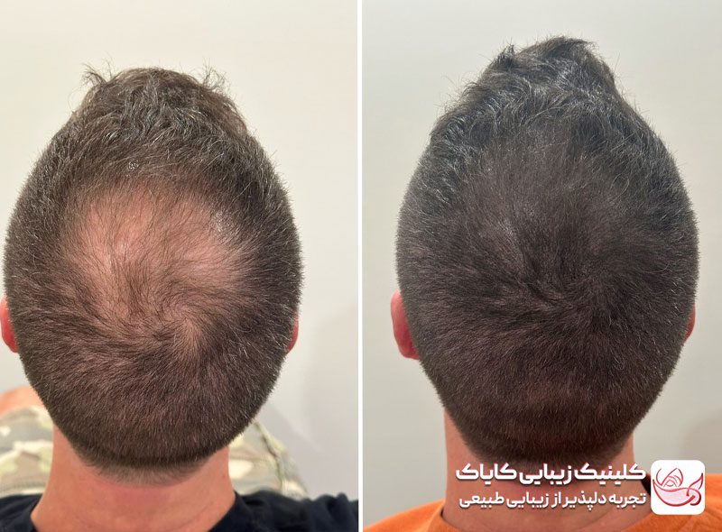 اسکالپ سر قبل و بعد - درمان ریزش مو