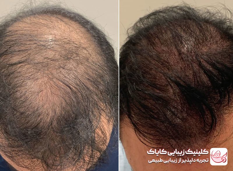 اسکالپ سر قبل و بعد