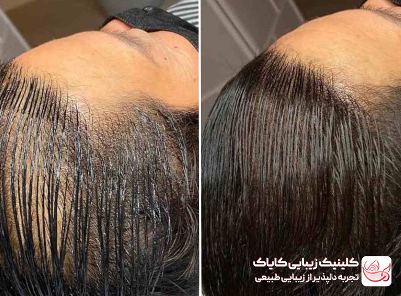 اسکالپ سر قبل و بعد