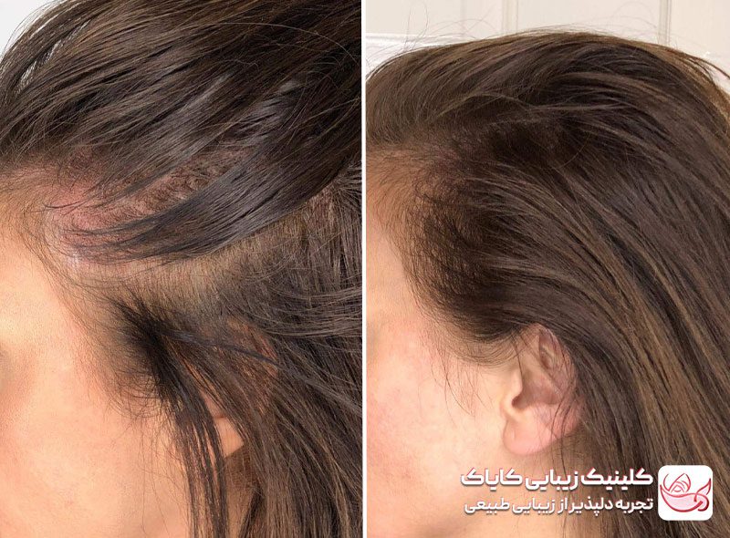 اسکالپ سر قبل و بعد