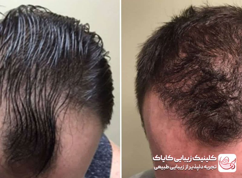 کاشت موی سر قبل و بعد