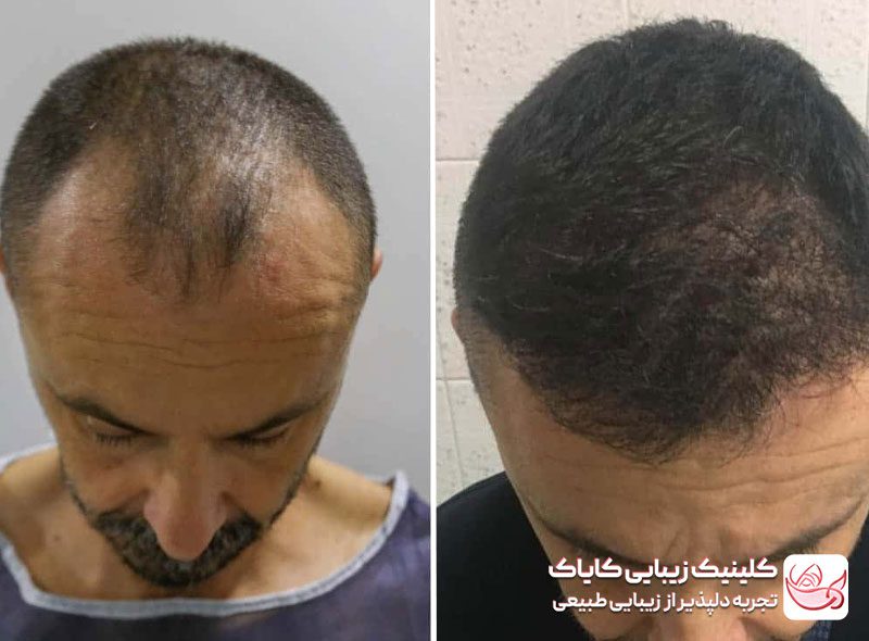 کاشت موی سر قبل و بعد