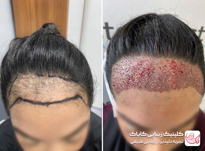 کاشت موی سر قبل و بعد