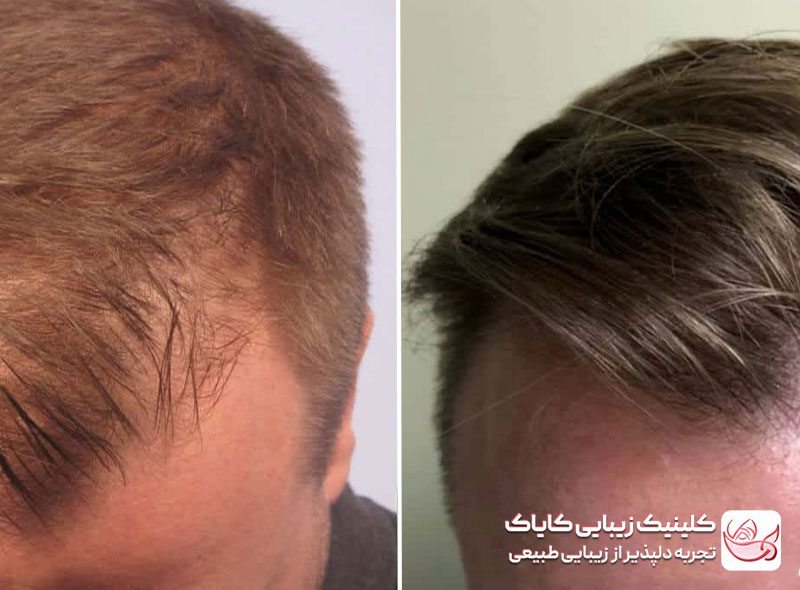 کاشت موی سر قبل و بعد
