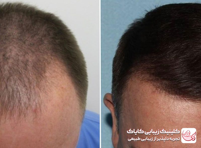 کاشت موی سر قبل و بعد