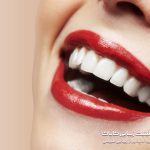 بوتاکس لب | لیفت لب با بوتاکس چیست و چه کاربردی دارد؟