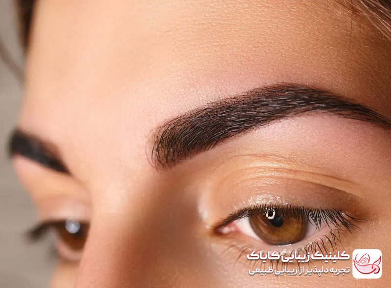 آیا کاشت ابرو دائمی است؟ بررسی ماندگاری نتایج این روش