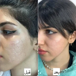 درمان جای جوش قبل و بعد ساریه امیدی
