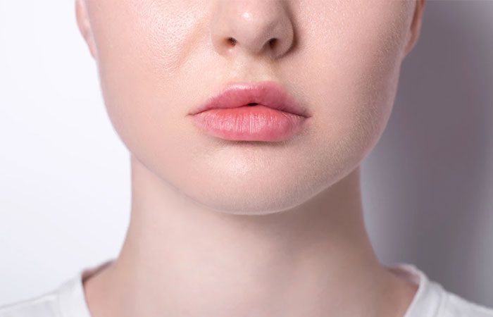 کج شدن لب بعد از تزریق ژل