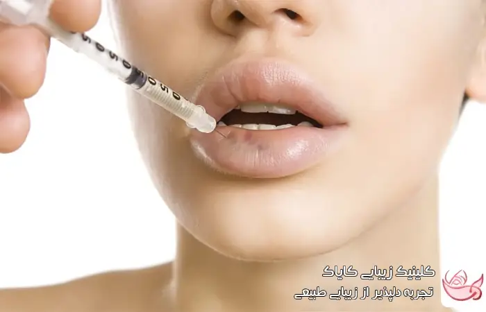 چگونه از ورم و کبودی پس از تزریق فیلر لب جلوگیری کنیم؟