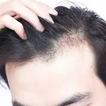 آیا اسکالپ تراپی برای ریزش موی ارثی هم جواب میدهد؟