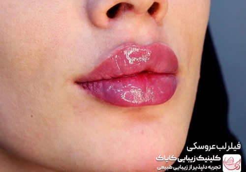 فیلر لب عروسکی- بهترین برند فیلر لب